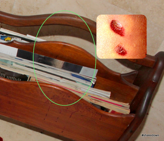 magazine rack and spine bruises